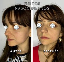 Rellenos Faciales - Estetica Casal