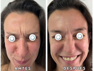 Botox antes y después - 872580