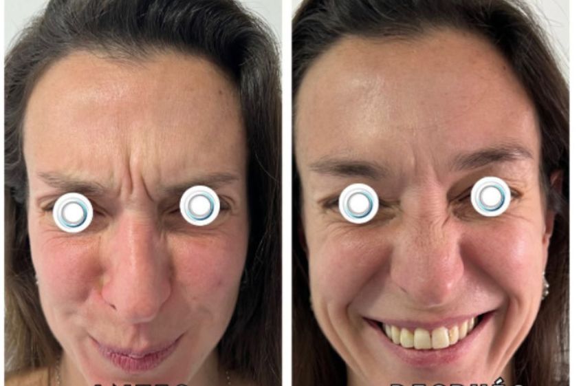 Botox antes y después - 872580