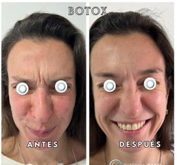 Botox - Estetica Casal