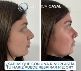 Rinoplastia - Estetica Casal