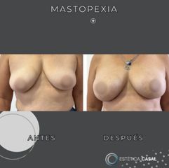 Mastopexia - Estetica Casal