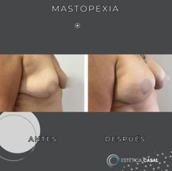 Mastopexia - Estetica Casal