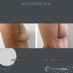 Mastopexia - Estetica Casal