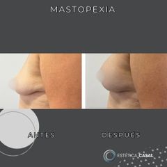 Mastopexia - Estetica Casal