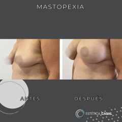 Mastopexia - Estetica Casal