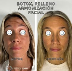 Rellenos Faciales - Estetica Casal