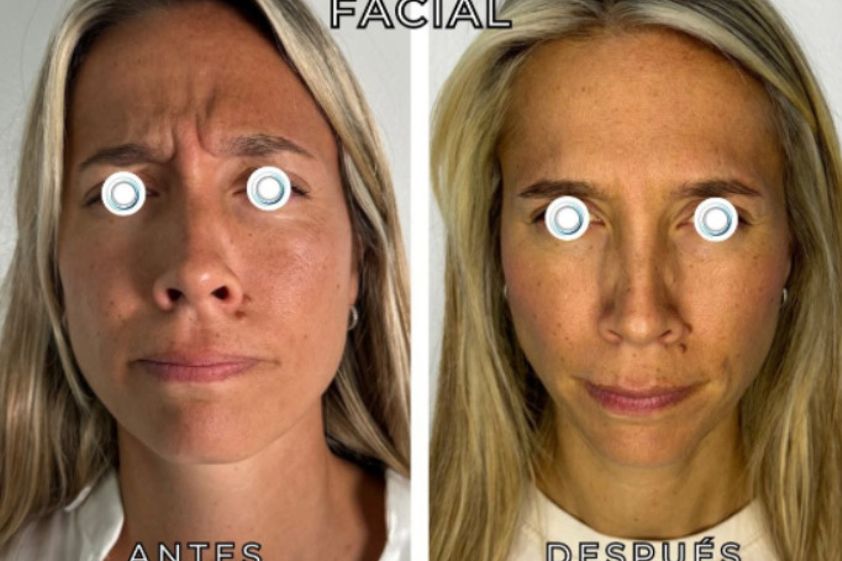 Botox antes y después - 872606