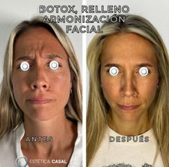 Rellenos Faciales - Estetica Casal