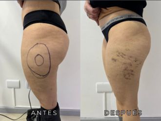 Liposucción antes y después - 872614