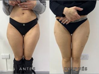 Liposucción antes y después - 872615