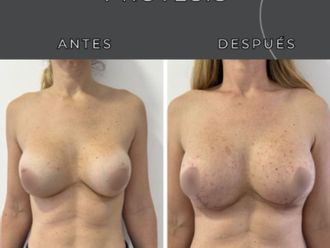 Aumento mamas antes y después - 877905