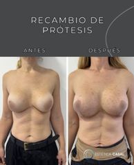 Recambio de Protesis - Estética Casal