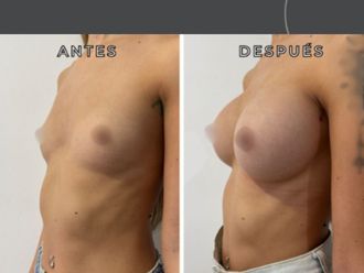 Aumento mamas antes y después - 877907