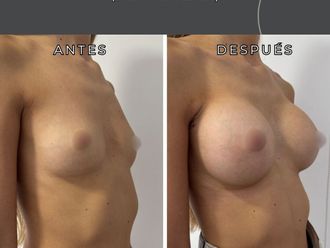 Aumento mamas antes y después - 877908