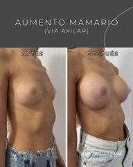 Aumento Mamas - Estética Casal