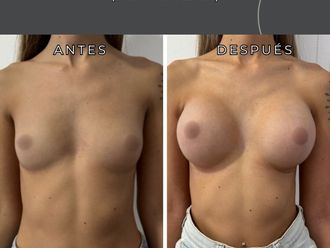 Aumento mamas antes y después - 877909