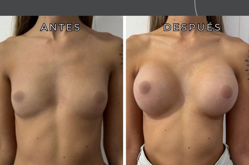 Aumento mamas antes y después - 877909
