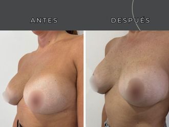 Mastopexia antes y después - 877910