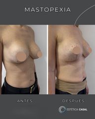 Mastopexia - Estetica Casal