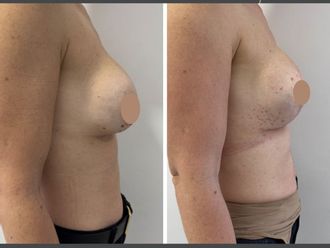 Mastopexia antes y después - 879791