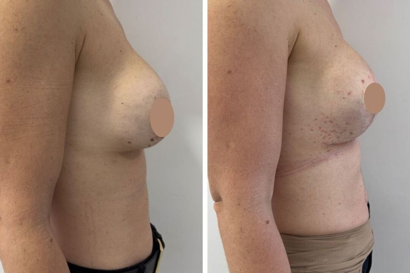 Mastopexia antes y después - 879791