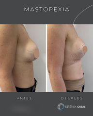 Mastopecia - Estetica Casal