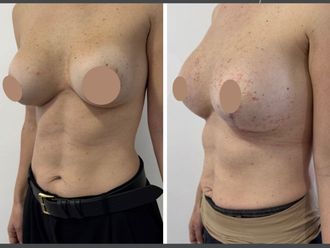 Mastopexia antes y después - 879792