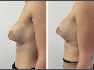 Mastopexia antes y después - 879793