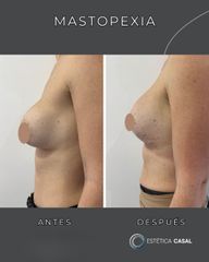 Mastopexia - Estetica Casal