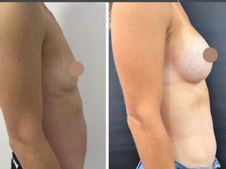 Dermolipectomía antes y después - 879795