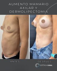 Aumento Mamario y Dermolipectomia