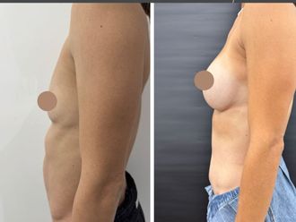 Dermolipectomía antes y después - 879797