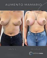 Aumento Mamario - Estetica Casal