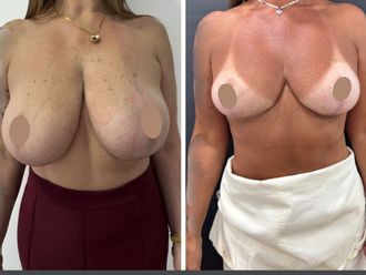 Reducción de mamas antes y después - 879803