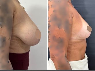 Reducción de mamas antes y después - 879805