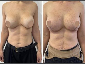 Mastopexia antes y después - 879808