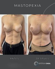 Mastopexia - Estetica Casal
