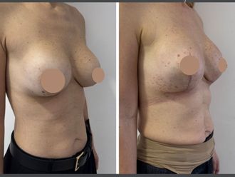 Mastopexia antes y después - 879809