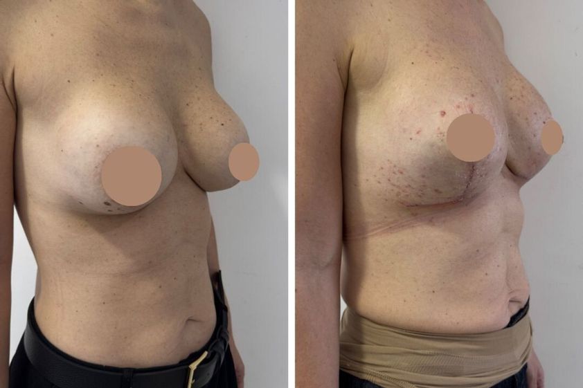 Mastopexia antes y después - 879809