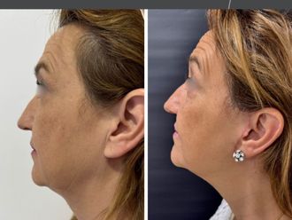 Lifting antes y después - 879810