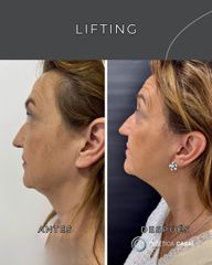 Lifting - Estetica Casal