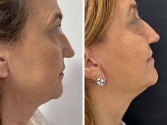 Lifting antes y después - 879811