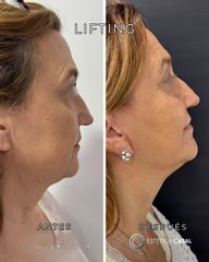 Lifting - Estetica Casal