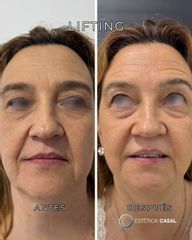Lifting - Estetica Casal