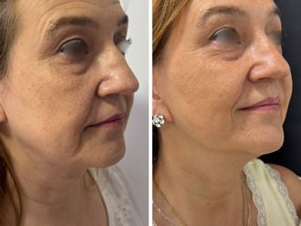Lifting antes y después - 879813