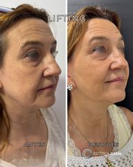 Lifting - Estetica Casal