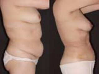 Lipoaspiración