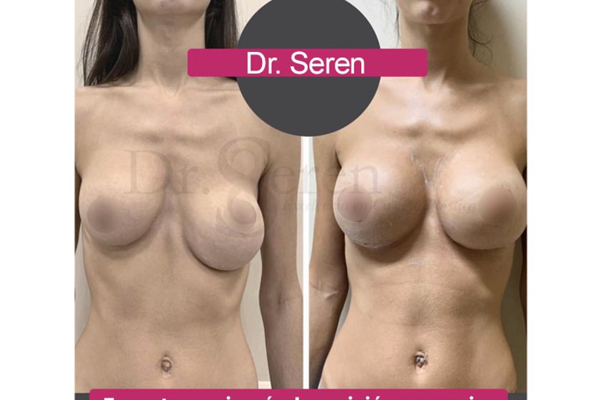 Mastopexia antes y después - 660333
