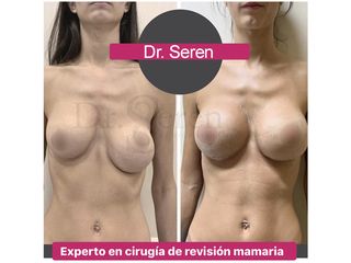 Mastopexia